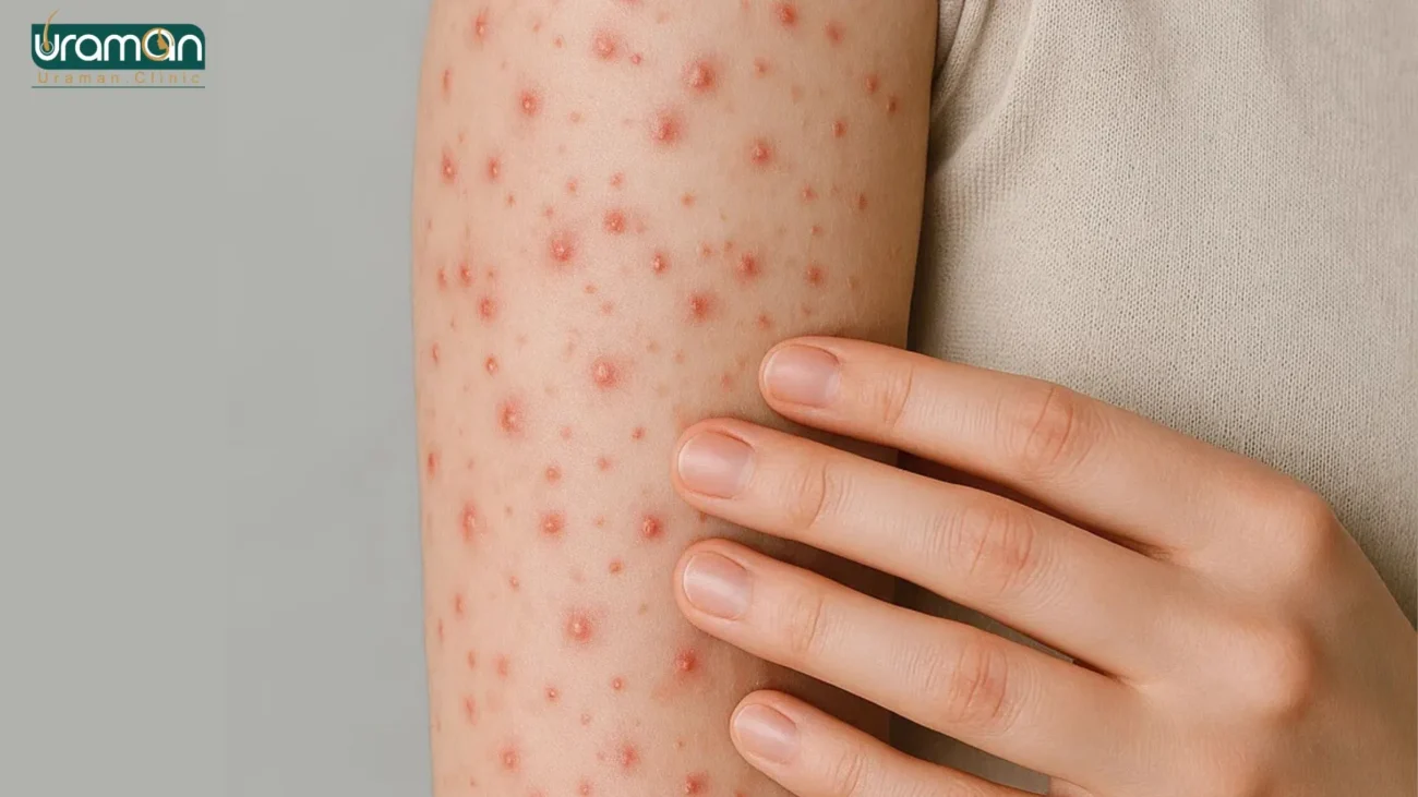 جوش روی بازو