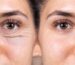 همه چیز در مورد بلفاروپلاستی (Blepharoplasty)