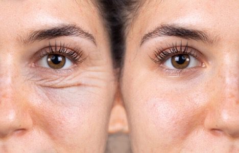 همه چیز در مورد بلفاروپلاستی (Blepharoplasty)