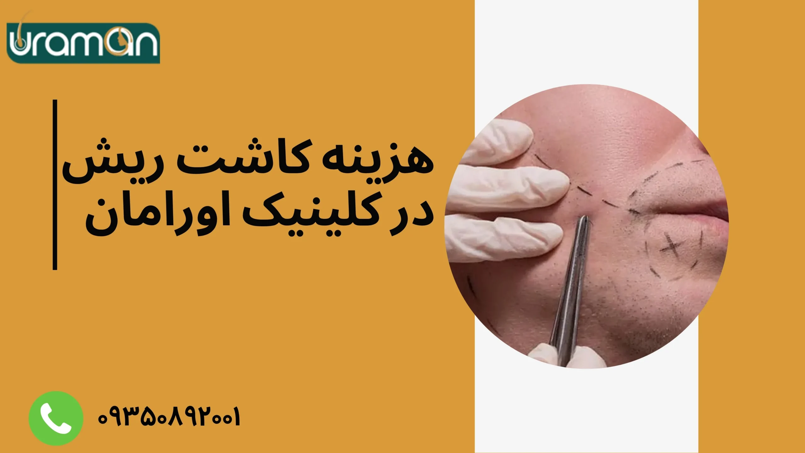 هزینه کاشت ریش