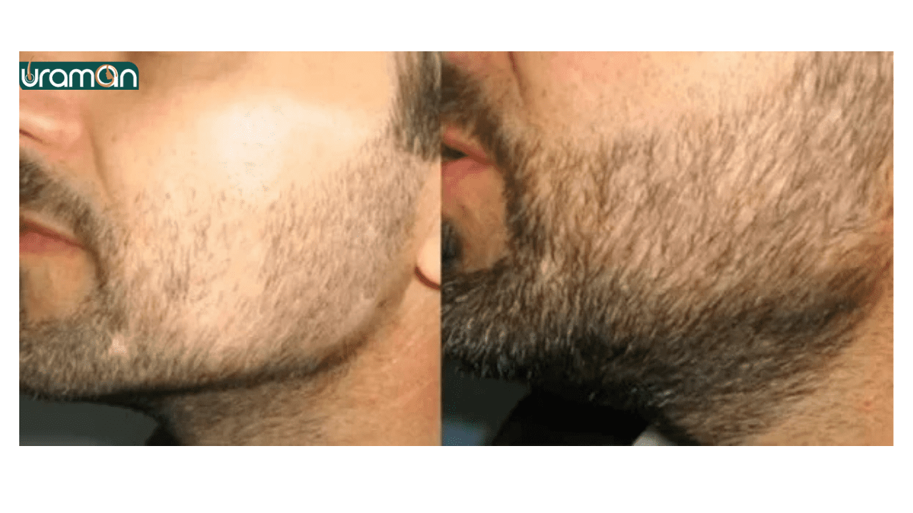 کاشت ریش قبل و بعد