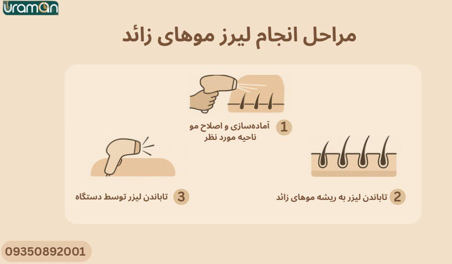 مراحل انجام لیزر