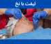 لیفت با نخ