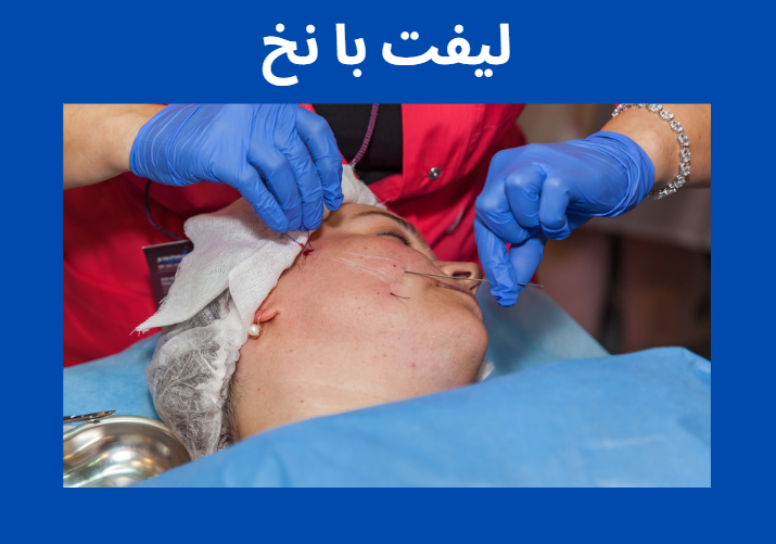 لیفت با نخ