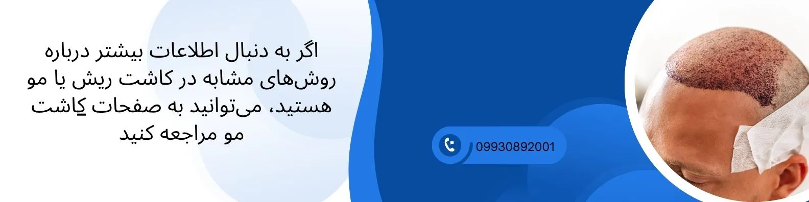 لینک به کاشت مو