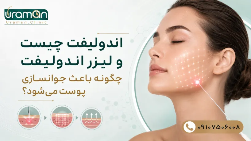 اندولیفت در قزوین چیست